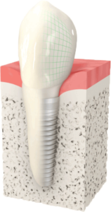 Odontoiatria Ancillotti | Implantologia dentale