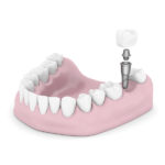 Odontoiatria Ancillotti | Implantologia a carico immediato