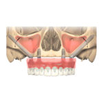 Odontoiatria Ancillotti | Zigomatica Ancilotti