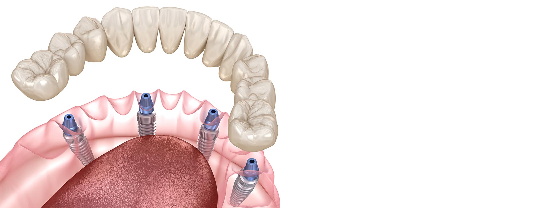 Odontoiatria Ancillotti | Carico immediato