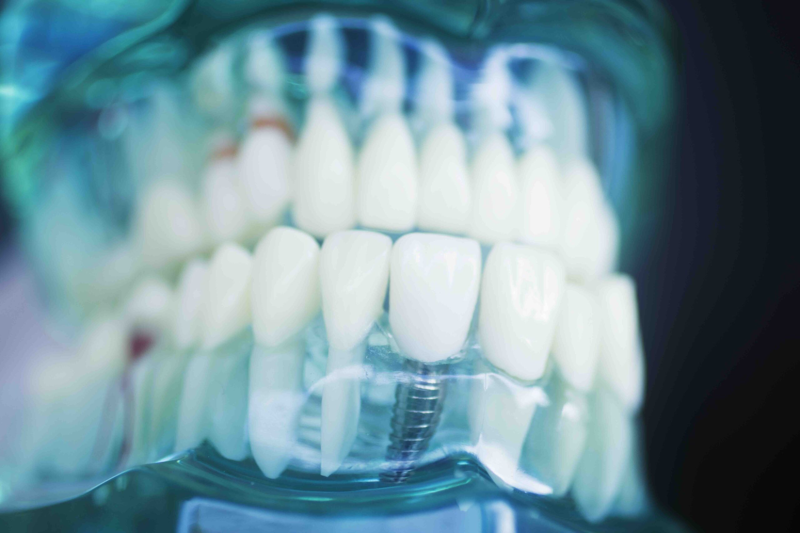 Glossario implantologia dentale
